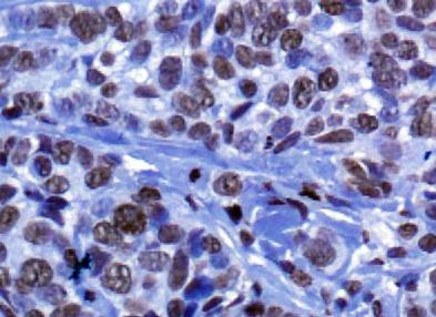 Histone H3 Antibody - Immunohistochemistry: Histone H3 Antibody - Analysis of Histone H3 in human breast cancer using DAB with hematoxylin counterstain.