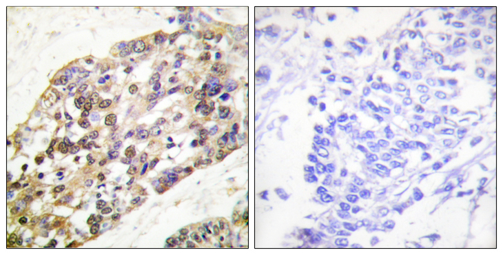 Histone H3 Antibody - Immunohistochemistry analysis of paraffin-embedded human breast carcinoma tissue, using Histone H3 Antibody. The picture on the right is blocked with the synthesized peptide.