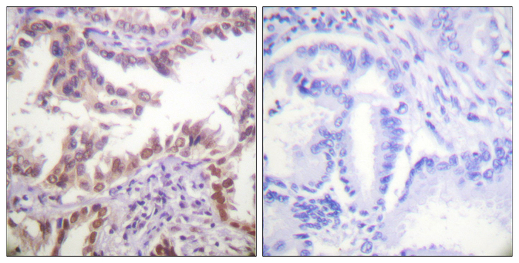 Histone H3 Antibody - Immunohistochemistry analysis of paraffin-embedded human lung carcinoma tissue, using Histone H3 Antibody. The picture on the right is blocked with the synthesized peptide.