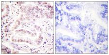 Histone H3 Antibody - Immunohistochemistry analysis of paraffin-embedded human lung carcinoma tissue, using Histone H3 (Acetyl-Lys27) Antibody. The picture on the right is blocked with the synthesized peptide.