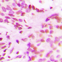 Histone H3 Antibody - Immunohistochemical analysis of Histone H3 (AcK27) staining in human breast cancer formalin fixed paraffin embedded tissue section. The section was pre-treated using heat mediated antigen retrieval with sodium citrate buffer (pH 6.0). The section was then incubated with the antibody at room temperature and detected using an HRP conjugated compact polymer system. DAB was used as the chromogen. The section was then counterstained with hematoxylin and mounted with DPX.