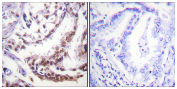Histone H3 Antibody - Immunohistochemistry analysis of paraffin-embedded human lung carcinoma tissue, using Histone H3 (Acetyl-Lys9) Antibody. The picture on the right is blocked with the synthesized peptide.