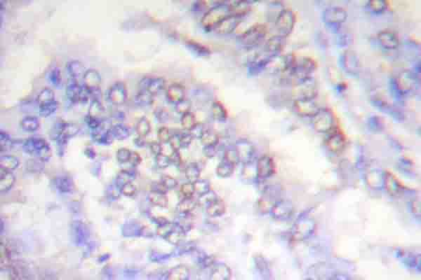 Histone H3 Antibody - IHC of Histone H3 (A1) pAb in paraffin-embedded human lung carcinoma tissue.