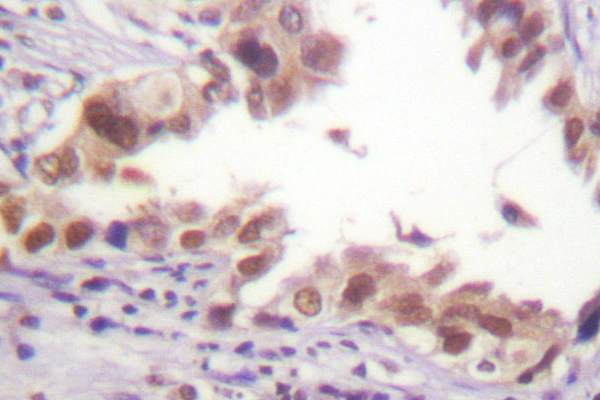 Histone H3 Antibody - IHC of Histone H3 (A7) pAb in paraffin-embedded human lung carcinoma tissue.