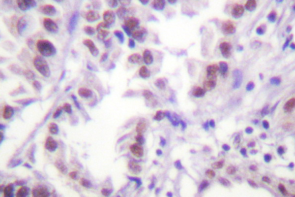 Histone H3 Antibody - IHC of Histone H3 (R2) pAb in paraffin-embedded human lung carcinoma tissue.