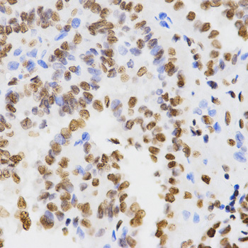 Histone H3 Antibody - Immunohistochemistry of paraffin-embedded human thyroid cancer tissue.