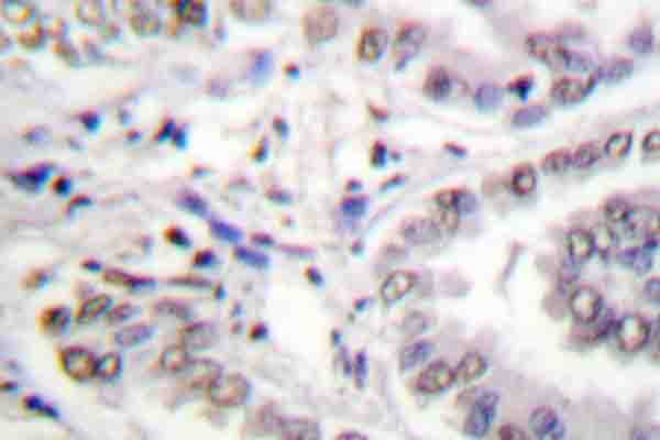 Histone H3 Antibody - Immunohistochemistry (IHC) analysis of Histone H3 (L20) pAb in paraffin-embedded human breast cancer tissue.