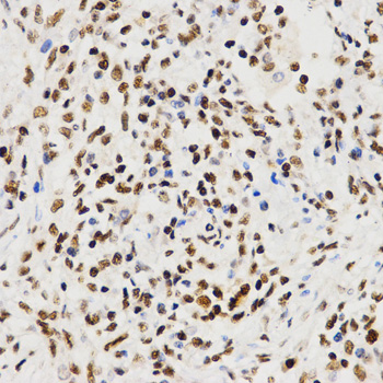 Histone H3 Antibody - Immunohistochemistry of paraffin-embedded human lung cancer tissue.