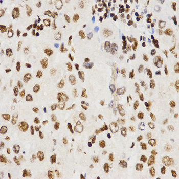 Histone H3 Antibody - Immunohistochemistry of paraffin-embedded human liver cancer tissue.
