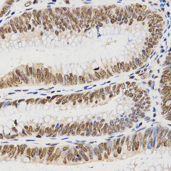 Histone H3 Antibody - Immunohistochemistry of paraffin-embedded human rectal cancer tissue.