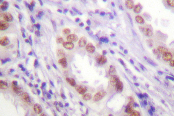 Histone H3 Antibody - IHC of Ac-Histone H3 (K9) pAb in paraffin-embedded human lung carcinoma tissue.