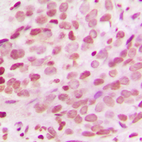 Histone H3 Antibody - Immunohistochemical analysis of Histone H3 staining in human breast cancer formalin fixed paraffin embedded tissue section. The section was pre-treated using heat mediated antigen retrieval with sodium citrate buffer (pH 6.0). The section was then incubated with the antibody at room temperature and detected using an HRP conjugated compact polymer system. DAB was used as the chromogen. The section was then counterstained with hematoxylin and mounted with DPX.