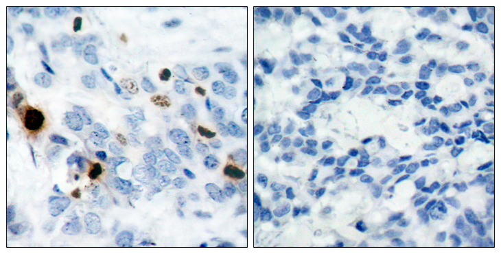 Histone H3 Antibody - Immunohistochemistry analysis of paraffin-embedded human breast carcinoma, using Histone H3.1 (Phospho-Ser10) Antibody. The picture on the right is blocked with the phospho peptide.