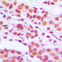Histone H3 Antibody - Immunohistochemical analysis of Histone H3 (pS10) staining in human breast cancer formalin fixed paraffin embedded tissue section. The section was pre-treated using heat mediated antigen retrieval with sodium citrate buffer (pH 6.0). The section was then incubated with the antibody at room temperature and detected using an HRP conjugated compact polymer system. DAB was used as the chromogen. The section was then counterstained with hematoxylin and mounted with DPX.