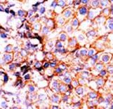 Histone H3 Antibody - Formalin-fixed and paraffin-embedded human cancer tissue reacted with the primary antibody, which was peroxidase-conjugated to the secondary antibody, followed by AEC staining. This data demonstrates the use of this antibody for immunohistochemistry; clinical relevance has not been evaluated. BC = breast carcinoma; HC = hepatocarcinoma.