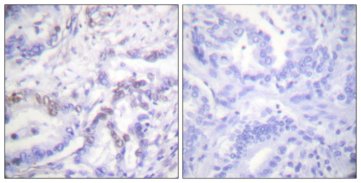 Histone H3 Antibody - Immunohistochemistry analysis of paraffin-embedded human lung carcinoma, using Histone H3 (Phospho-Thr3) Antibody. The picture on the right is blocked with the phospho peptide.