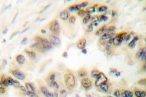 Histone H3 Antibody - IHC of Histone H3 (T11) pAb in paraffin-embedded human lung carcinoma tissue.