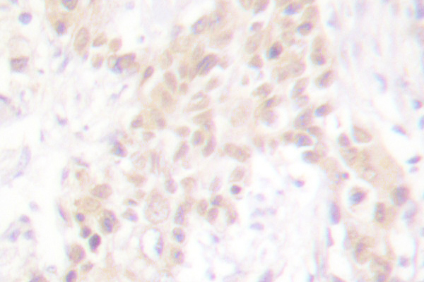 Histone H3 Antibody - IHC of Histone H3 (T22) pAb in paraffin-embedded human breast carcinoma.