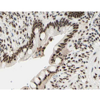 Histone H3.1 Antibody - 1:200 staining human colon carcinoma tissue by IHC-P. The tissue was formaldehyde fixed and a heat mediated antigen retrieval step in citrate buffer was performed. The tissue was then blocked and incubated with the antibody for 1.5 hours at 22°C. An HRP conjugated goat anti-rabbit antibody was used as the secondary.