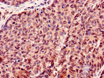 Histone H3.3 Antibody - Immunohistochemistry of paraffin-embedded human ovarian cancer using H3F3A Antibody at dilution of 1:100