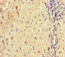 Histone H3.3 Antibody - Immunohistochemistry of paraffin-embedded human liver cancer using H3F3A Antibody at dilution of 1:100