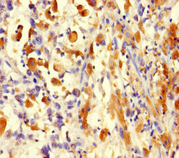 Histone H3.3 Antibody - Immunohistochemistry of paraffin-embedded human melanoma using H3F3A Antibody at dilution of 1:100