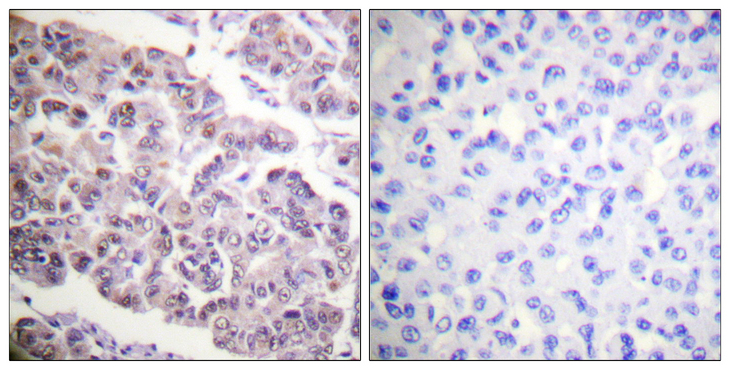Histone H4 Antibody - Immunohistochemistry analysis of paraffin-embedded human breast carcinoma tissue, using Histone H4 (Acetyl-Lys12) Antibody. The picture on the right is blocked with the synthesized peptide.