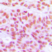 Histone H4 Antibody - Immunohistochemical analysis of Histone H4 (AcK12) staining in human breast cancer formalin fixed paraffin embedded tissue section. The section was pre-treated using heat mediated antigen retrieval with sodium citrate buffer (pH 6.0). The section was then incubated with the antibody at room temperature and detected using an HRP conjugated compact polymer system. DAB was used as the chromogen. The section was then counterstained with hematoxylin and mounted with DPX.