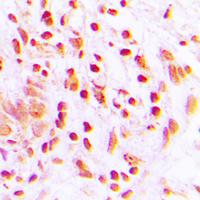 Histone H4 Antibody - Immunohistochemical analysis of Histone H4 (AcK16) staining in human lung cancer formalin fixed paraffin embedded tissue section. The section was pre-treated using heat mediated antigen retrieval with sodium citrate buffer (pH 6.0). The section was then incubated with the antibody at room temperature and detected using an HRP conjugated compact polymer system. DAB was used as the chromogen. The section was then counterstained with hematoxylin and mounted with DPX.
