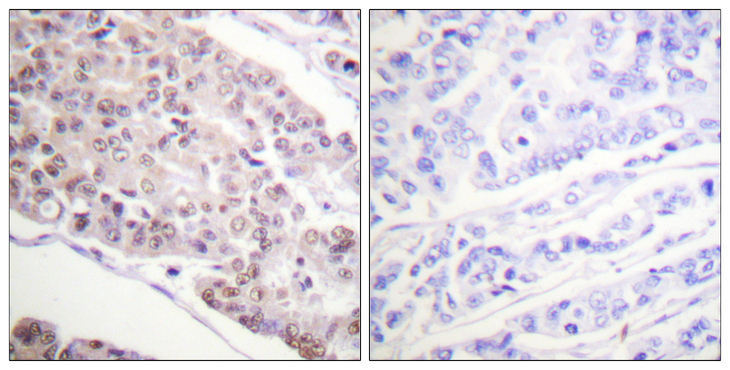 Histone H4 Antibody - Immunohistochemistry analysis of paraffin-embedded human breast carcinoma tissue, using Histone H4 (Acetyl-Lys8) Antibody. The picture on the right is blocked with the synthesized peptide.