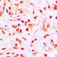 Histone H4 Antibody - Immunohistochemical analysis of Histone H4 (AcK8) staining in human lung cancer formalin fixed paraffin embedded tissue section. The section was pre-treated using heat mediated antigen retrieval with sodium citrate buffer (pH 6.0). The section was then incubated with the antibody at room temperature and detected using an HRP conjugated compact polymer system. DAB was used as the chromogen. The section was then counterstained with hematoxylin and mounted with DPX.