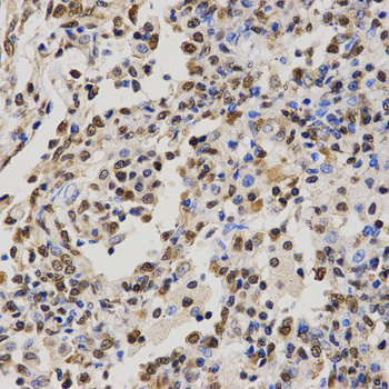 Histone H4 Antibody - Immunohistochemistry of paraffin-embedded human lung cancer tissue.