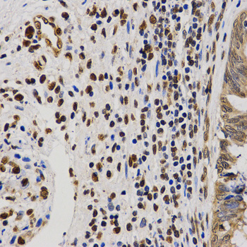 Histone H4 Antibody - Immunohistochemistry of paraffin-embedded human rectal cancer tissue.