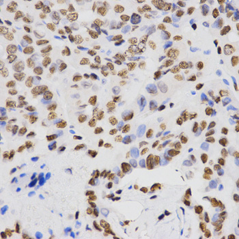 Histone H4 Antibody - Immunohistochemistry of paraffin-embedded human thyroid cancer tissue.