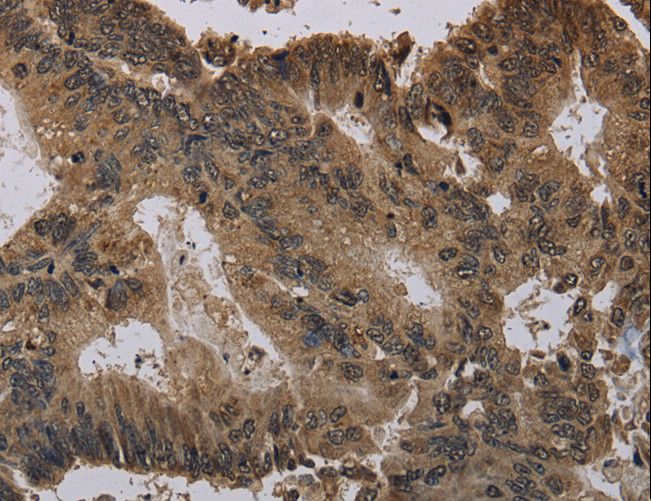 Histone H4 Antibody - Immunohistochemistry of paraffin-embedded Human colon cancer using HIST4H4 Polyclonal Antibody at dilution of 1:30.