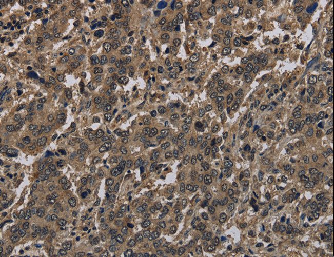 Histone H4 Antibody - Immunohistochemistry of paraffin-embedded Human liver cancer using HIST4H4 Polyclonal Antibody at dilution of 1:30.