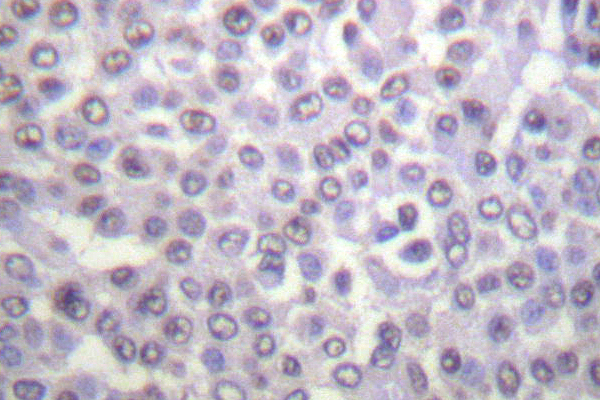 Histone H4 Antibody - IHC of Ac-Histone H4 (K12) pAb in paraffin-embedded human breast carcinoma tissue.