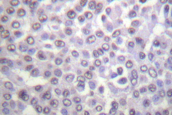 Histone H4 Antibody - IHC of Histone H4 (K5) pAb in paraffin-embedded human breast carcinoma tissue.