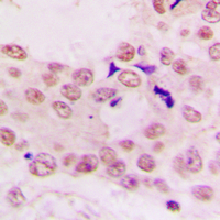 Histone H4 Antibody - Immunohistochemical analysis of Histone H4 staining in human lung cancer formalin fixed paraffin embedded tissue section. The section was pre-treated using heat mediated antigen retrieval with sodium citrate buffer (pH 6.0). The section was then incubated with the antibody at room temperature and detected using an HRP conjugated compact polymer system. DAB was used as the chromogen. The section was then counterstained with hematoxylin and mounted with DPX.