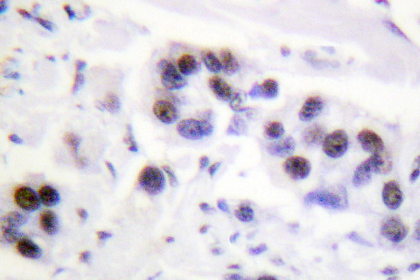 Histone H4 Antibody - IHC of Histone H4 (S1) pAb in paraffin-embedded human breast carcinoma tissue.