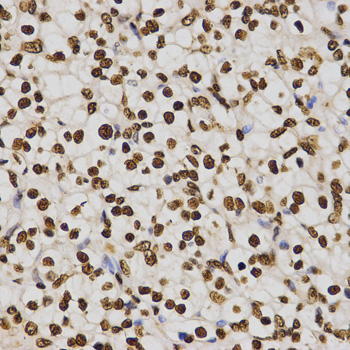 Histone H4 Antibody - Immunohistochemistry of paraffin-embedded human kidney cancer tissue.