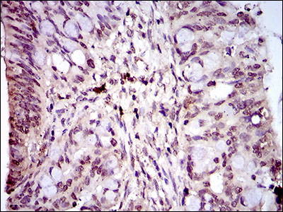 HIWI2 / PIWIL4 Antibody - IHC of paraffin-embedded rectum cancer tissues using PIWIL4 mouse monoclonal antibody with DAB staining.