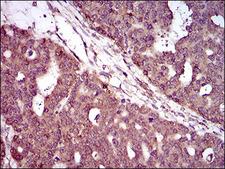 HIWI2 / PIWIL4 Antibody - IHC of paraffin-embedded ovarian cancer tissues using PIWIL4 mouse monoclonal antibody with DAB staining.