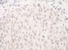 HJURP Antibody - Detection of Human HJURP by Immunohistochemistry. Sample: FFPE section of human skin carcinoma. Antibody: Affinity purified rabbit anti-HJURP used at a dilution of 1:1000 (1 ug/mg).
