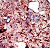 HK1 / Hexokinase 1 Antibody - Formalin-fixed and paraffin-embedded human cancer tissue reacted with the primary antibody, which was peroxidase-conjugated to the secondary antibody, followed by DAB staining. This data demonstrates the use of this antibody for immunohistochemistry; clinical relevance has not been evaluated. BC = breast carcinoma; HC = hepatocarcinoma.