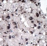 HK2 / Hexokinase 2 Antibody - Formalin-fixed and paraffin-embedded human cancer tissue reacted with the primary antibody, which was peroxidase-conjugated to the secondary antibody, followed by DAB staining. This data demonstrates the use of this antibody for immunohistochemistry; clinical relevance has not been evaluated. BC = breast carcinoma; HC = hepatocarcinoma.
