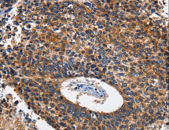 HK2 / Hexokinase 2 Antibody - Immunohistochemistry of paraffin-embedded Human lung cancer using HK2 Polyclonal Antibody at dilution of 1:60.