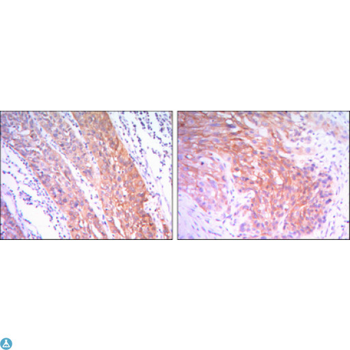 HK2 / Hexokinase 2 Antibody - Immunohistochemistry (IHC) analysis of paraffin-embedded esophagus cancer tissues (left) and Human Lung Cancer (right) with DAB staining using HXK II Monoclonal Antibody.