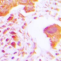 HK3 / Hexokinase 3 Antibody - Immunohistochemical analysis of Hexokinase 3 staining in human lung cancer formalin fixed paraffin embedded tissue section. The section was pre-treated using heat mediated antigen retrieval with sodium citrate buffer (pH 6.0). The section was then incubated with the antibody at room temperature and detected using an HRP conjugated compact polymer system. DAB was used as the chromogen. The section was then counterstained with hematoxylin and mounted with DPX.