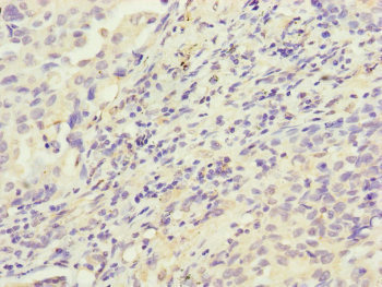 HK3 / Hexokinase 3 Antibody - Immunohistochemistry of paraffin-embedded human lung cancer at dilution of 1:100
